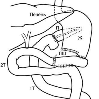 Панкреатодуоденальная резекция схема операции